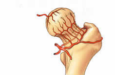 股骨头缺血性坏死早期为何不易诊断