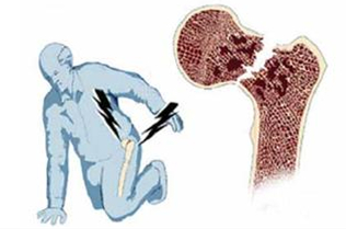 股骨颈骨折为何容易发生股骨头缺血性坏死