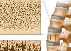 骨质疏松