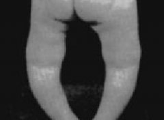 引发佝偻病的病因有哪些？