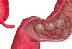 引发大肠癌的因素有哪些？