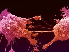 8大癌症早期信号要注意