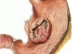 有哪些不良饮食习惯会导致胃癌？