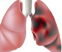 诱发女性肺癌的常见因素有哪些？