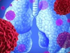 肺癌会有哪些早期症状？