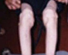 肌肉萎缩的诊断要点有哪些？