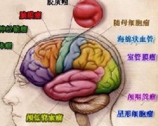 脑癌可分为哪些类型？