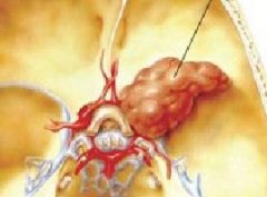 不同类型的脑瘤症状不同