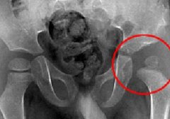 外伤性股骨头坏死的病因有哪些？