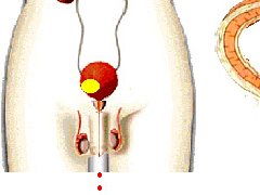 膀胱癌的早期症状有哪些？