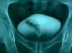 膀胱癌的晚期症状是怎样的？