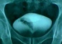 膀胱癌的检查方法有哪些？