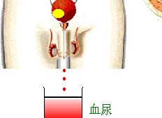 膀胱癌需要与哪些疾病鉴别诊断？