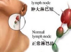 淋巴癌的检查方法有哪些？
