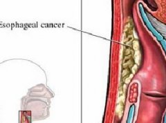 食道癌的预防方法有哪些？