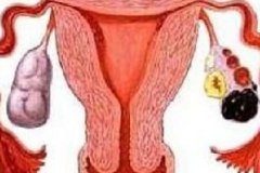 诱发卵巢囊肿的原因有哪些？