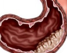 胃癌常有哪些检查方法？