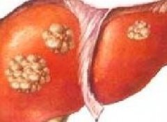 肝癌有哪些早期症状？