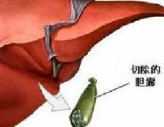 胆囊癌一般有哪些症状？