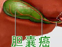 胆囊癌的常见病因有哪些？