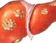 肝癌的晚期症状有哪些？