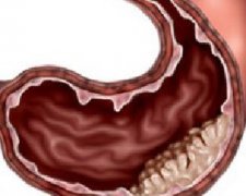 胃癌的早期症状有什么？