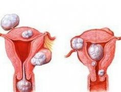 子宫肌瘤常有哪些症状表现？