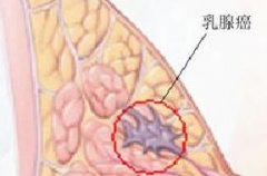 乳腺癌的早期信号有哪些？