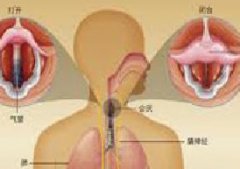 诊断喉癌的检查方法有哪些？
