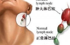 淋巴癌的早期症状有哪些？