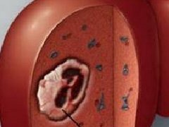 预防肝癌的方法有哪些？