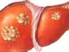 诱发肝癌的因素有哪些？