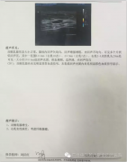 我院成功完成第一例乳腺包块安珂微创旋切手术