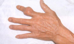 【健康】不吃海鲜痛风就不会发作？关于痛风你该多了解一点