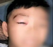 6岁男童注射狂犬疫苗13天后死亡，敲响狂犬病预防警钟！