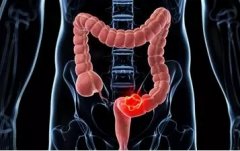 【消化故事荟】大便这件事其实真的“大”，如有异常表现要警惕！