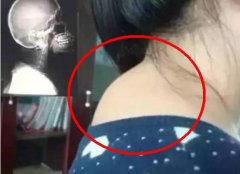 后颈“富贵包”并不富贵，一不小心可能变成夺命包