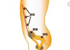 我院泌尿外科顺利完成首例达芬奇机器人辅助腹腔镜下脐尿管癌根治