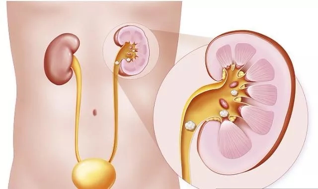 2岁幼儿发现肾结石，泌尿科微创经皮肾镜取石术解难题！