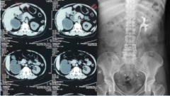 输尿管狭窄别怕，“黑科技”ALLIUM输尿管支架解困扰