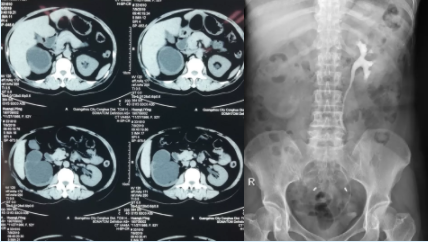 输尿管狭窄别怕,“黑科技”ALLIUM输尿管支架解困扰 输尿管狭窄别怕,“黑科技”ALLIUM输尿管支架解困扰