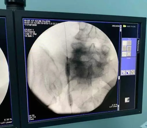 输尿管狭窄别怕,“黑科技”ALLIUM输尿管支架解困扰 输尿管狭窄别怕,“黑科技”ALLIUM输尿管支架解困扰