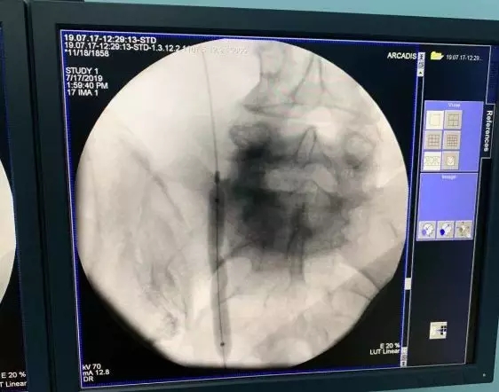 输尿管狭窄别怕,“黑科技”ALLIUM输尿管支架解困扰 输尿管狭窄别怕,“黑科技”ALLIUM输尿管支架解困扰