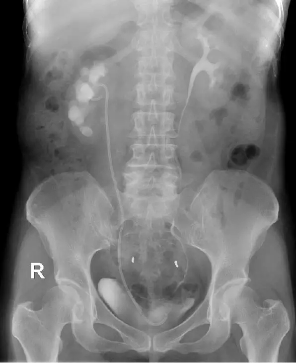 输尿管狭窄别怕，“黑科技”ALLIUM输尿管支架解困扰