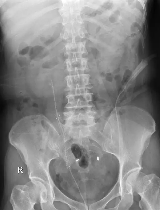 输尿管狭窄别怕，“黑科技”ALLIUM输尿管支架解困扰