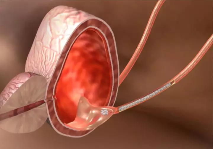 输尿管狭窄别怕,“黑科技”ALLIUM输尿管支架解困扰 输尿管狭窄别怕,“黑科技”ALLIUM输尿管支架解困扰