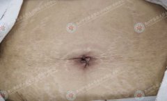 手术不留痕，美丽不打折！我院妇科团队成功开展单孔腹腔镜手术