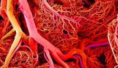 我院肾病风湿科成功治疗一例ANCA相关性血管炎