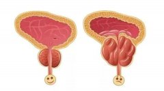 关注中老年男性健康：前列腺增生了，会癌变吗？