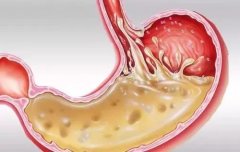 健康饮食：胃酸反流的杀伤力有多大？